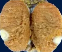 SERTOLI CELL TUMOR 