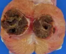 SERTOLI CELL TUMOR