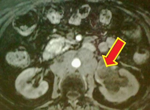SMALL CELL CARCINOMA RENAL PELVIS