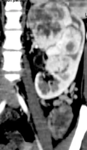 SOLITARY FIBROUS RENAL TUMOR