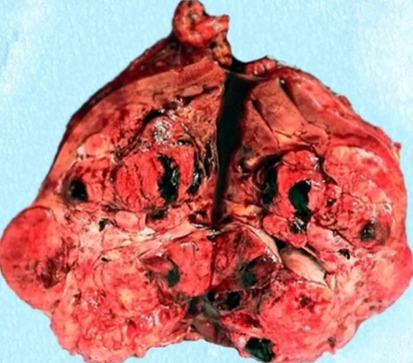 SOLITARY FIBROUS RENAL TUMOR 