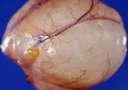 SPERMATOCELE