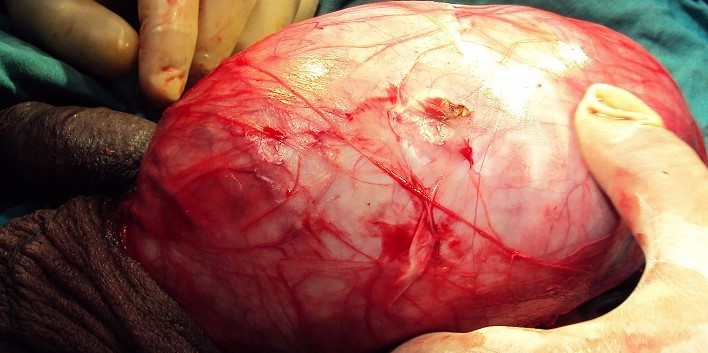 SPERMATOCYTIC SEMINOMA 