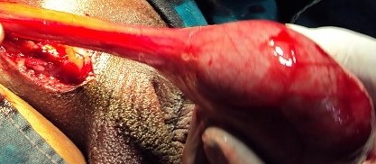 SPERMATOCYTIC SEMINOMA 