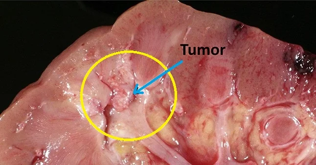SQUAMOUS CARCINOMA CALYCEAL