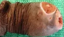 PENILE SQUAMOUS CELL CARCINOMA