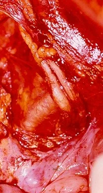 DOUBLE URETER SYSTEM