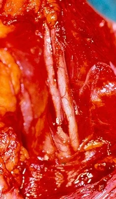 DOUBLE URETER SYSTEM