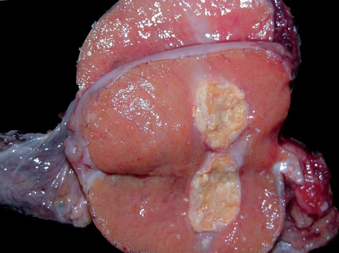 TESTICULAR CALCULUS