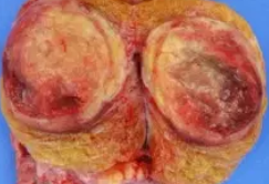 TESTICULAR CARCINOID