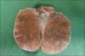 TESTICULAR LEYDIG CELL TUMOR