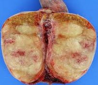 TESTICULAR LYMPHOMA