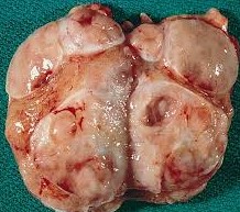TESTICULAR LYMPHOMA