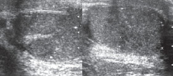 TESTICULAR MICROLITHIASIS - SEMINOMA