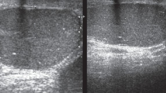 TESTICULAR MICROLITHIASIS 