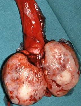 TESTICULAR SEMINOMA