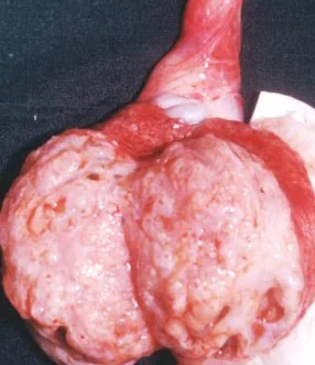 TESTICULAR TERATOMA
