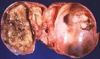 TESTICULAR TERATOMA