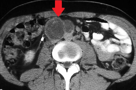 TESTICULAR TERATOMA 
