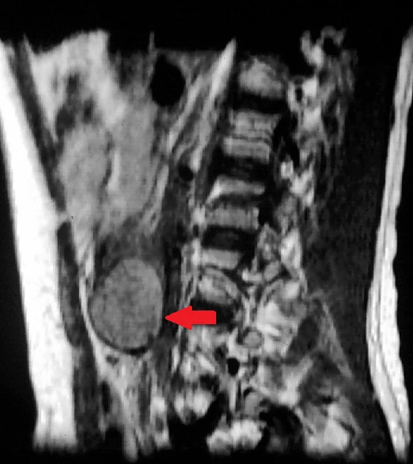 TESTICULAR TERATOMA