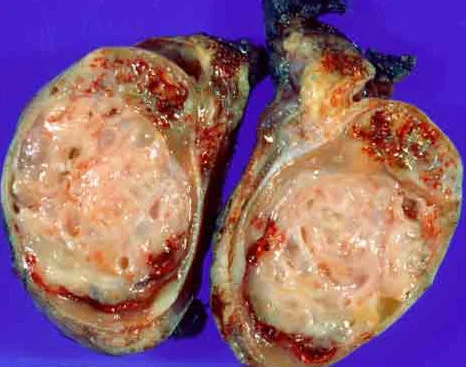 TESTICULAR TERATOMA