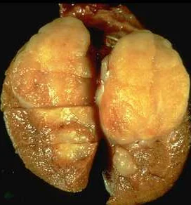 TESTICULAR TUMOR