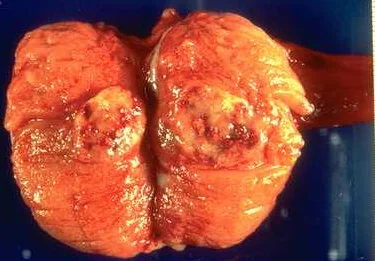 TESTICULAR TUMOR