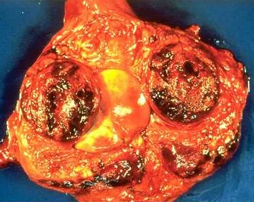 TESTICULAR TUMOR