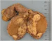 TUNICA VAGINALIS TESTICULAR TUMOR