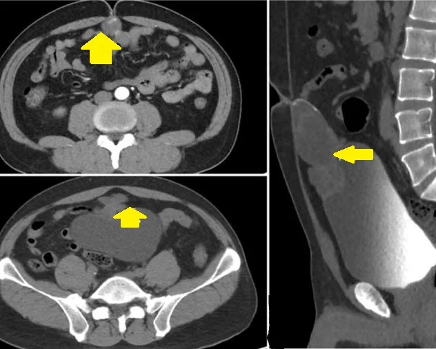 URACHAL MUCINOUS CYSTADENOMA 