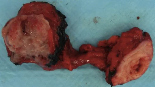 URACHAL MUCINOUS CYSTADENOMA