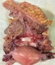 URACHAL TUMOR 