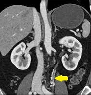 URETERAL VARICES 