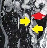 URETERAL VARICES