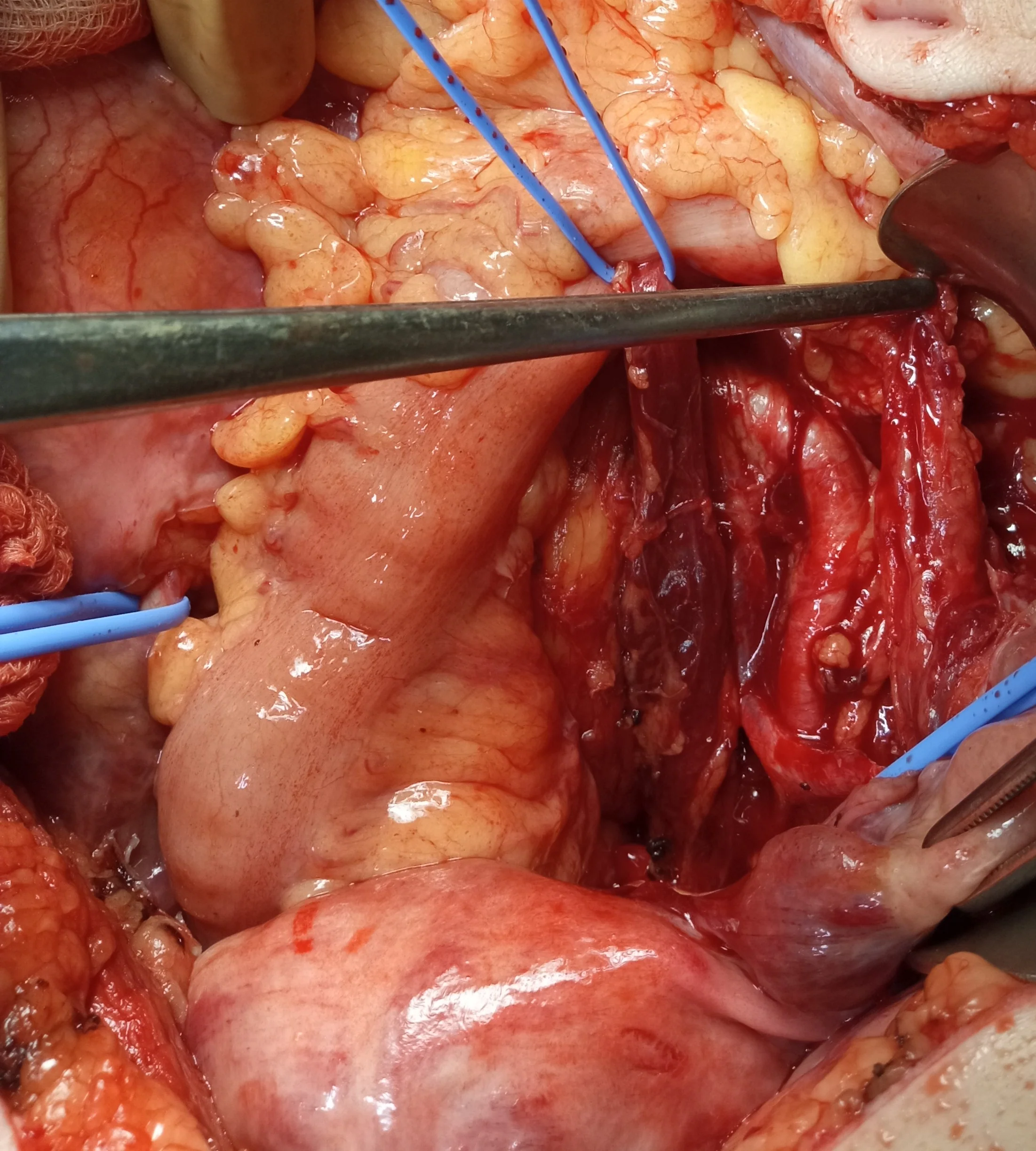 URETERAL VARICES