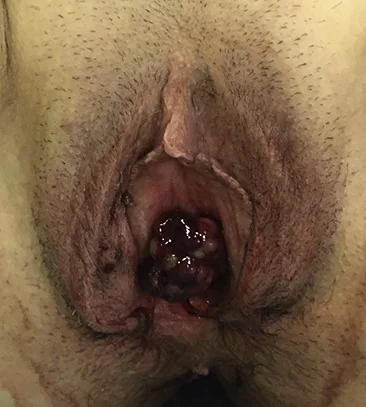 URETHRAL MELANOMA