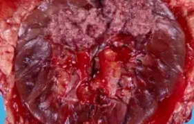 UROTHELIAL CARCINOMA RENAL PELVIS