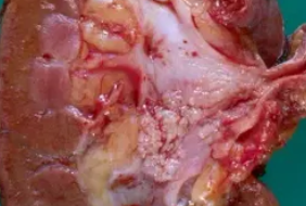 UROTHELIAL CARCINOMA RENAL PELVIS 