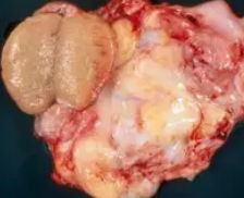 WELL DIFFERENTIATED LIPOSARCOMA