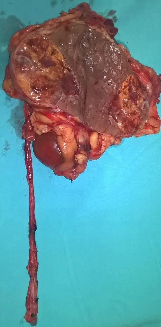 RENAL CARCINOMA