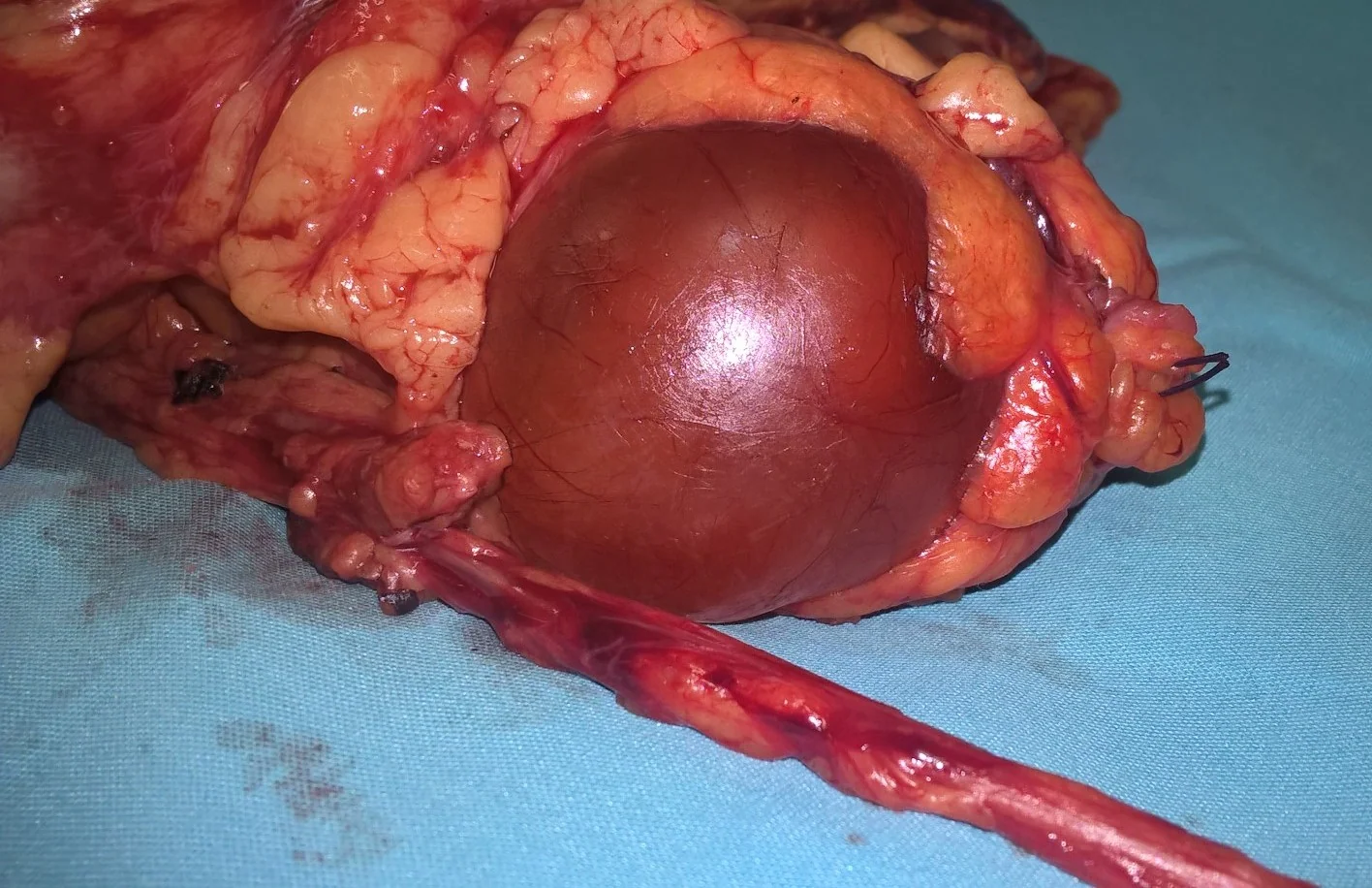RENAL CARCINOMA