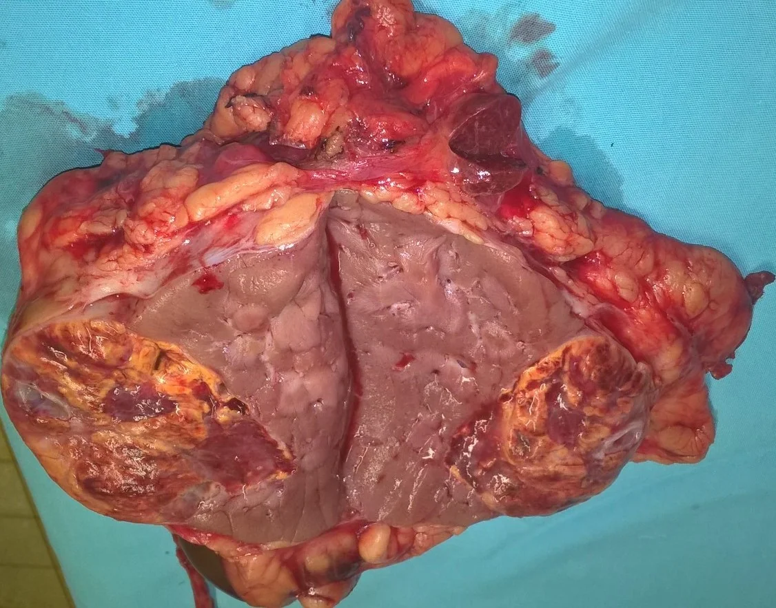 RENAL CARCINOMA