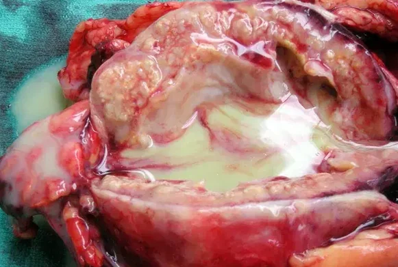 XANTHOGRANULOMATOUS PYELONEPHRITIS