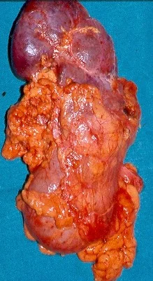 PYONEPHROSIS - NEPHRECTOMY