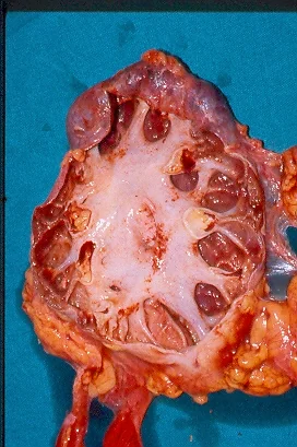 PYONEPHROSIS - NEPHRECTOMY