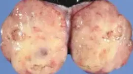 YOLK SAC TUMOR