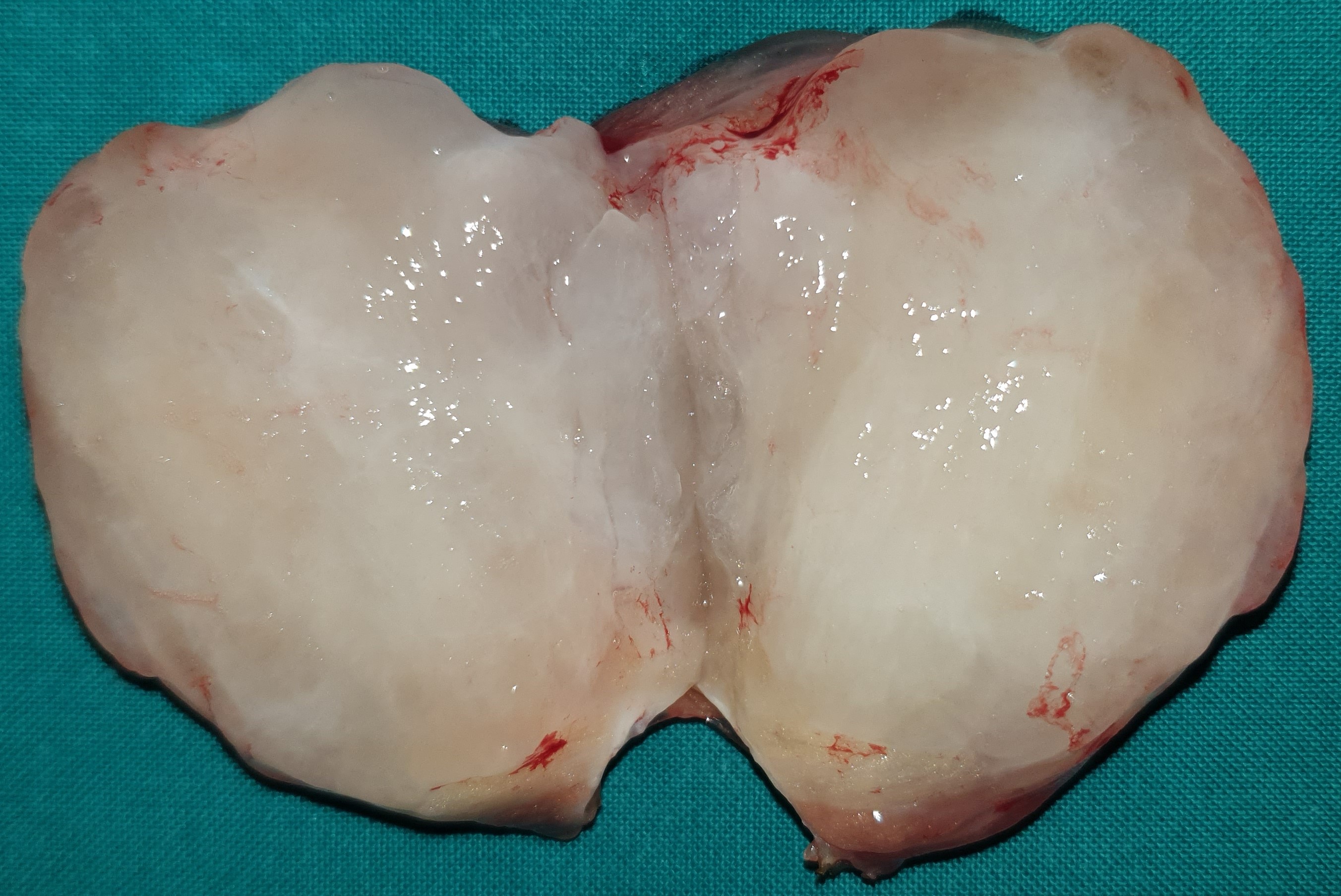 INTRAMUSCULAR MYXOMA