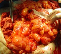 FAMILIAL LIPOMATOSIS 