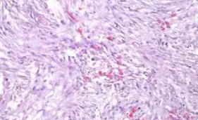 NODULAR FASCIITIS