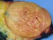 SPINDLE CELL LIPOMA